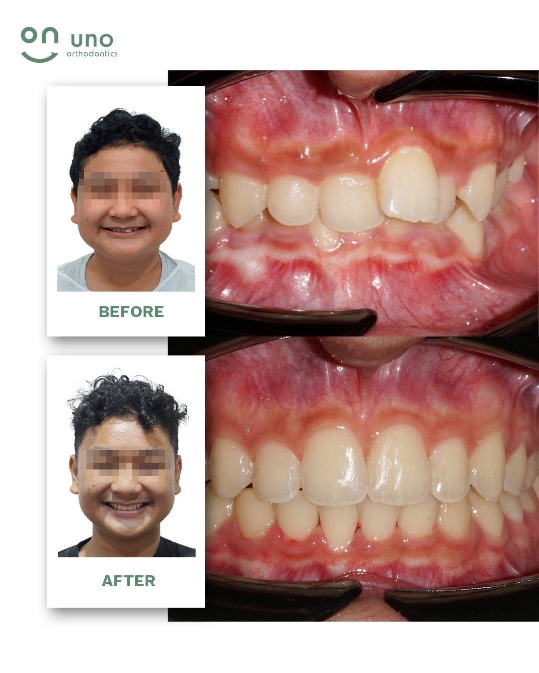 R / Crooked Upper and Lower Teeth, Deep Bite