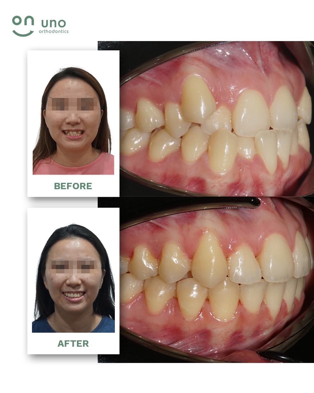 R / Crooked Upper and Lower Teeth, Crossbite