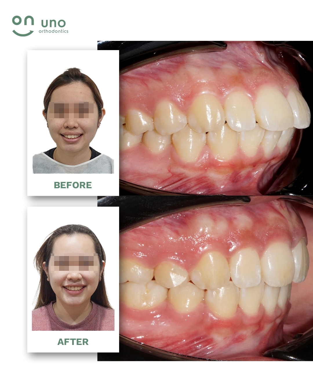 Ms. A / Protuding Front Teeth